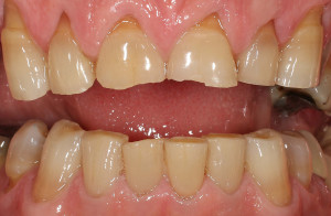 Střední destrukce zubů v předním úseku zubů v horní a dolní čelisti