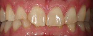 Těžká destrukce zubů v předním úseku chrupu